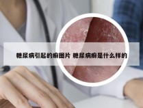 糖尿病引起的癣图片 糖尿病癣是什么样的