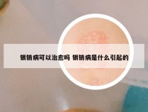 银销病可以治愈吗 银销病是什么引起的