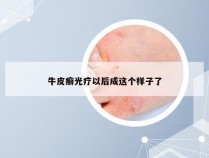 牛皮癣光疗以后成这个样子了