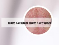 脚癣怎么治能除根 脚癣怎么治才能断根