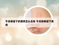 牛皮癣留下的黑斑怎么去除 牛皮肤癣留下黑疤