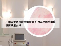 广州三甲医院治疗银屑病 广州三甲医院治疗银屑病怎么样