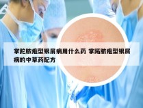 掌跎脓疱型银屑病用什么药 掌跖脓疱型银屑病的中草药配方