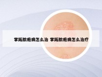 掌跖脓疱病怎么治 掌跖脓疱病怎么治疗