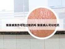 银屑病发作可吃过敏药吗 银屑病人可以吃药