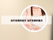 治疗皮癣的秘方 治疗皮癣的偏方