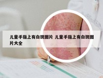 儿童手指上有白斑图片 儿童手指上有白斑图片大全