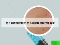 怎么去除皮肤癣快 怎么去除皮肤癣快速方法