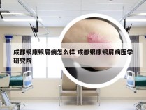 成都银康银屑病怎么样 成都银康银屑病医学研究院