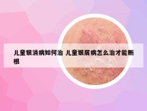 儿童银消病如何治 儿童银屑病怎么治才能断根