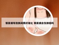 银屑病导致肺间质纤维化 银屑病会生肺癌吗