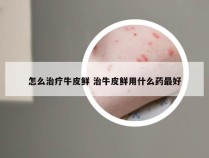 怎么治疗牛皮鲜 治牛皮鲜用什么药最好