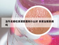 治牛皮癣吃青黛胶囊和什么好 青黛治银屑病吗