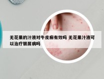 无花果的汁液对牛皮癣有效吗 无花果汁液可以治疗银屑病吗