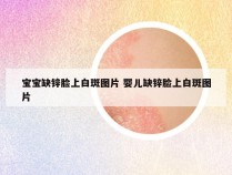 宝宝缺锌脸上白斑图片 婴儿缺锌脸上白斑图片