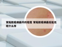 掌跖脓疱病最坏的程度 掌跖脓疱病最后能出现什么样