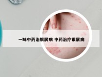 一味中药治银屑病 中药治疗银屑病