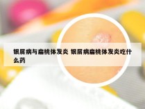 银屑病与扁桃体发炎 银屑病扁桃体发炎吃什么药