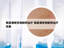 银屑病吧生物制剂治疗 银屑病生物制剂治疗效果