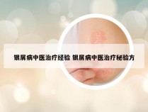 银屑病中医治疗经验 银屑病中医治疗秘验方