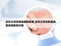 急性泛发性脓疱病银屑病 急性泛发性脓疱病银屑病鉴别诊断