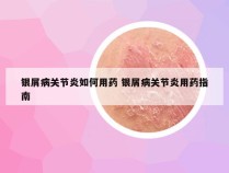 银屑病关节炎如何用药 银屑病关节炎用药指南