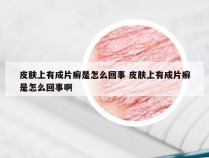 皮肤上有成片癣是怎么回事 皮肤上有成片癣是怎么回事啊