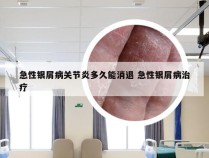 急性银屑病关节炎多久能消退 急性银屑病治疗