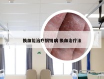 换血能治疗银销病 换血治疗法