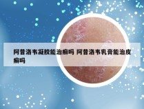 阿昔洛韦凝胶能治癣吗 阿昔洛韦乳膏能治皮癣吗