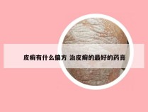 皮癣有什么偏方 治皮癣的最好的药膏