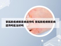 掌跖脓疱病银屑病遗传吗 掌跖脓疱病银屑病遗传吗能治好吗