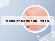 银屑病照UVB 银屑病照光治疗一次多少钱