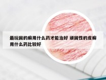 最玩固的癣用什么药才能治好 顽固性的皮癣用什么药比较好