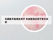 头癣能不能用达克宁 头皮藓涂达克宁多久会好