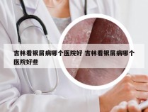 吉林看银屑病哪个医院好 吉林看银屑病哪个医院好些