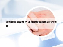 头部银屑病痒死了 头部银屑病痒得不行怎么办