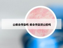 口癣会传染吗 癣会传染到口腔吗