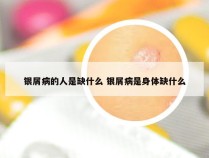 银屑病的人是缺什么 银屑病是身体缺什么