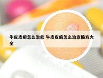 牛皮皮癣怎么治愈 牛皮皮癣怎么治愈偏方大全