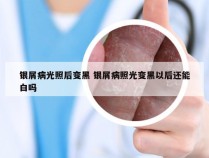 银屑病光照后变黑 银屑病照光变黑以后还能白吗