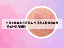 小事小孩身上有癣怎么 小孩身上长癣怎么办 癣的种类与辨别