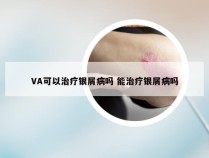 VA可以治疗银屑病吗 能治疗银屑病吗