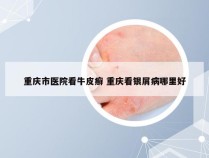 重庆市医院看牛皮癣 重庆看银屑病哪里好