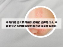 手背的旁边长的像癣似的裂口还痒是什么 手背的旁边长的像癣似的裂口还痒是什么原因