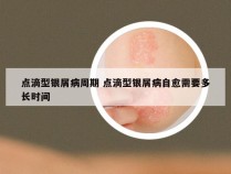 点滴型银屑病周期 点滴型银屑病自愈需要多长时间