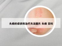 头癣的症状和治疗方法图片 头癣 百科