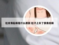 肚皮像起癣是什么原因 肚子上长了很像皮癣