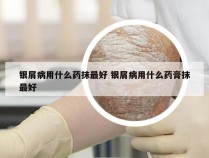 银屑病用什么药抹最好 银屑病用什么药膏抹最好