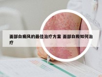 面部白癜风的最佳治疗方案 面部白殿如何治疗